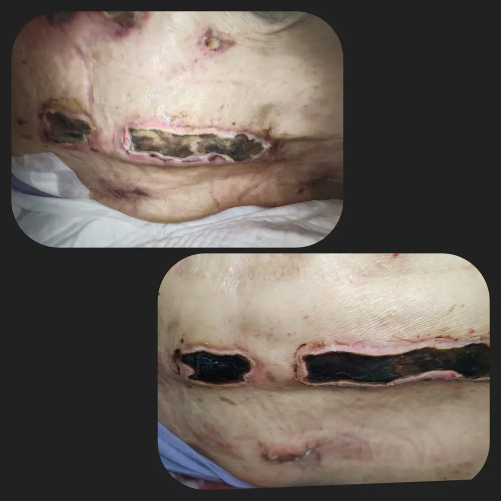 Cuidado de escara — antes y después.