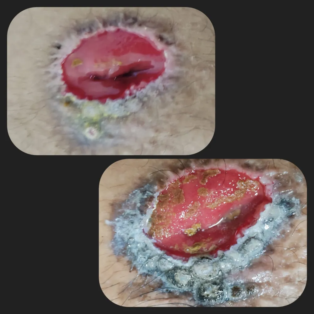 Tratamiento de colostomía por presencia de granulomas.