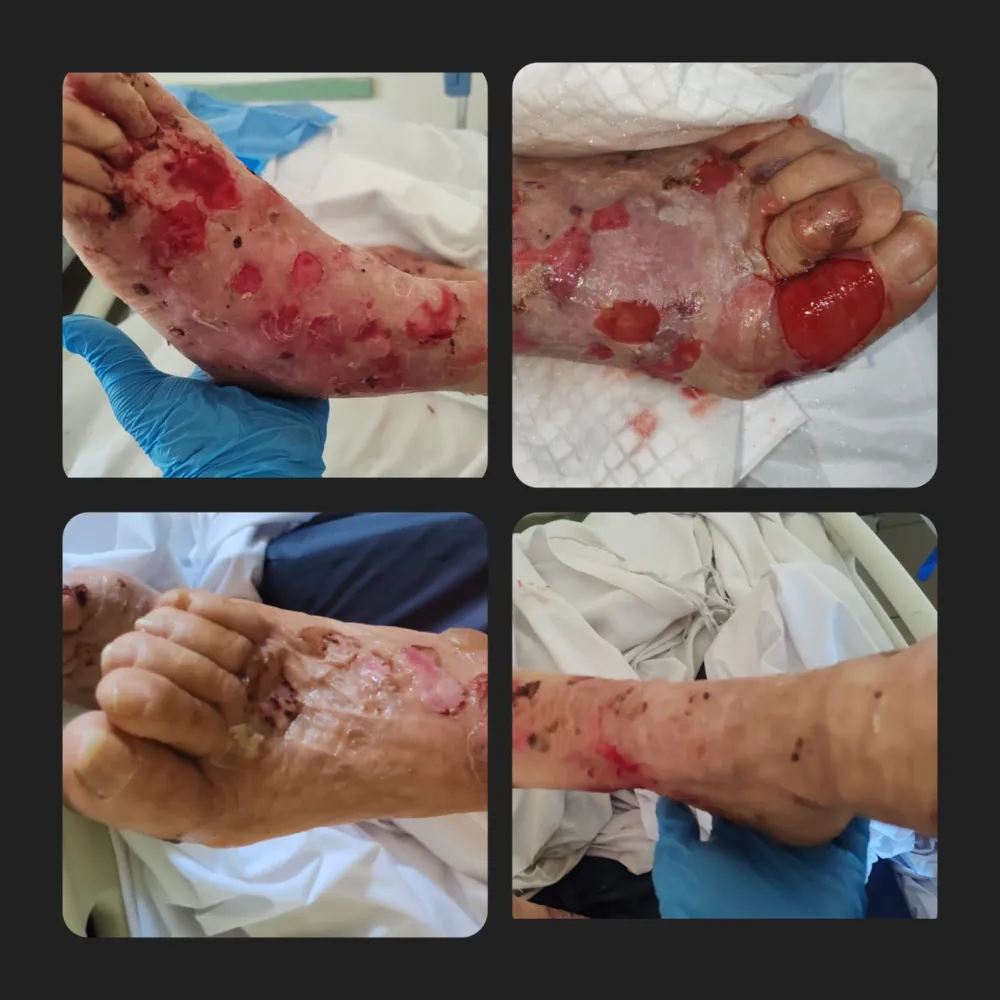Pénfigo bulloso (enfermedad autoinmune) recuperado.